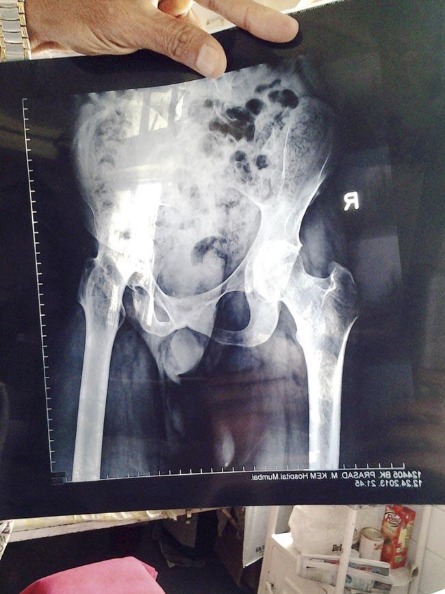 Dr Pradeep Bhosale said though the condition is quite common, it usually remains undiagnosed and leads to fusion of bones and immobility