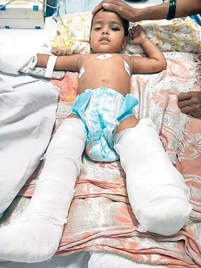 Samruddhi Nagte will be ready for prosthesis within two months