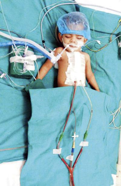 After the operation, ten-month-old Sakshi Acharya can expect to lead a normal life