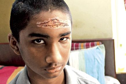 Mumbai teen hit by debris from construction site won't be able to swim, cycle