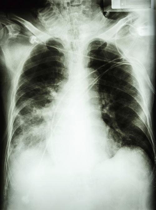 Pneumonia x-ray