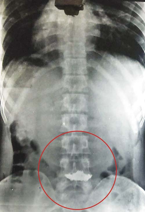 In X-ray scans, the pendant can be seen lodged in Anil Yadav’s food pipe