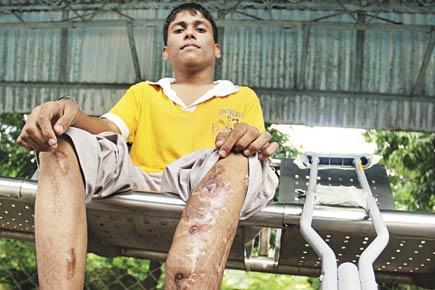Six 'Make Me Tall' surgeries later, Mumbai teen can now barely walk