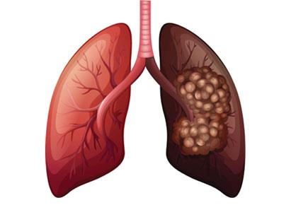 Biomarker of early lung cancer identified