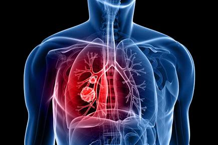 Lung cancer now top cancer killer for women in rich nations