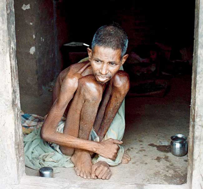 malnourished child