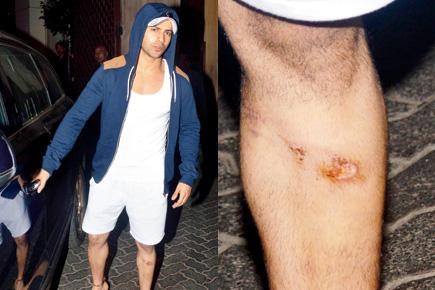 Varun Dhawan recuperating after having gashed his knee