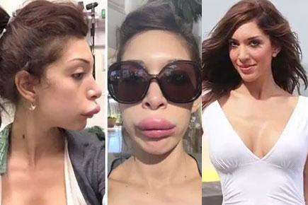Farrah Abraham's failed lip surgery