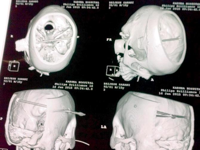 The MRI scan show the arrow lodged in Brijesh Sahani