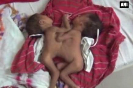 Rare conjoined twins, sharing single liver born in Rajasthan