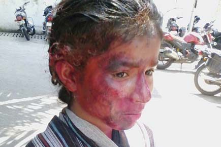 Teen suffers skin reaction during Holi after boys pour acidic colour on her
