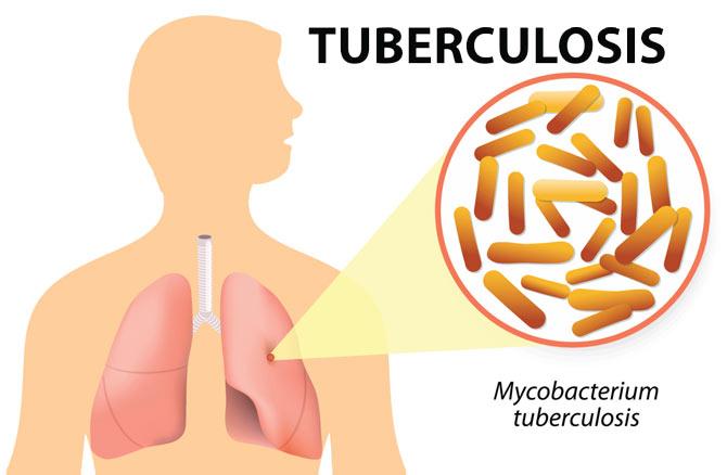 Tuberculosis