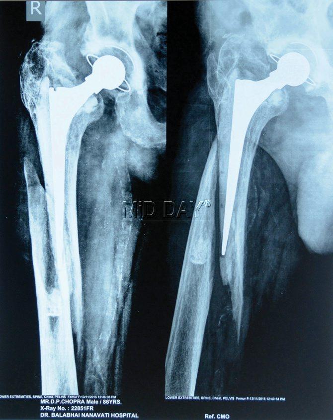 X-ray highlighting the damage. Pics/Satej Shinde