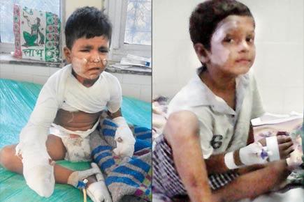Mumbai: Children bear the brunt of cracker injuries during Diwali