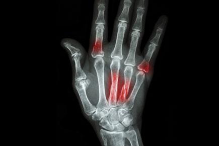 Diabetes drug may boost fracture risk