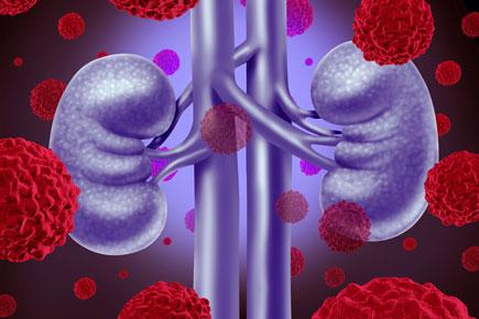 Belly fat big concern for women with kidney cancer
