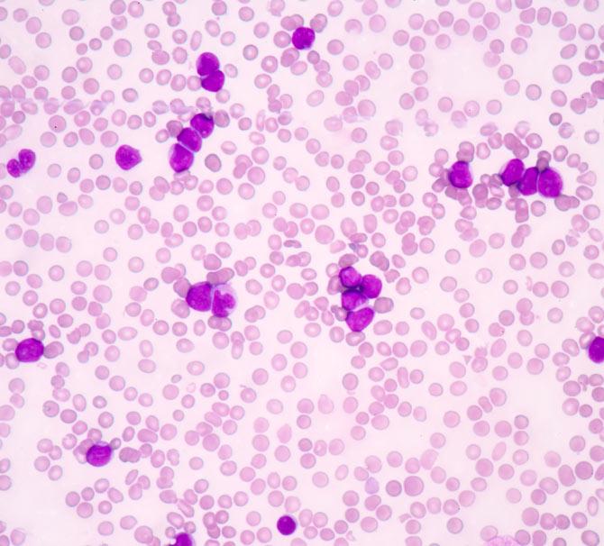 Lymphoma