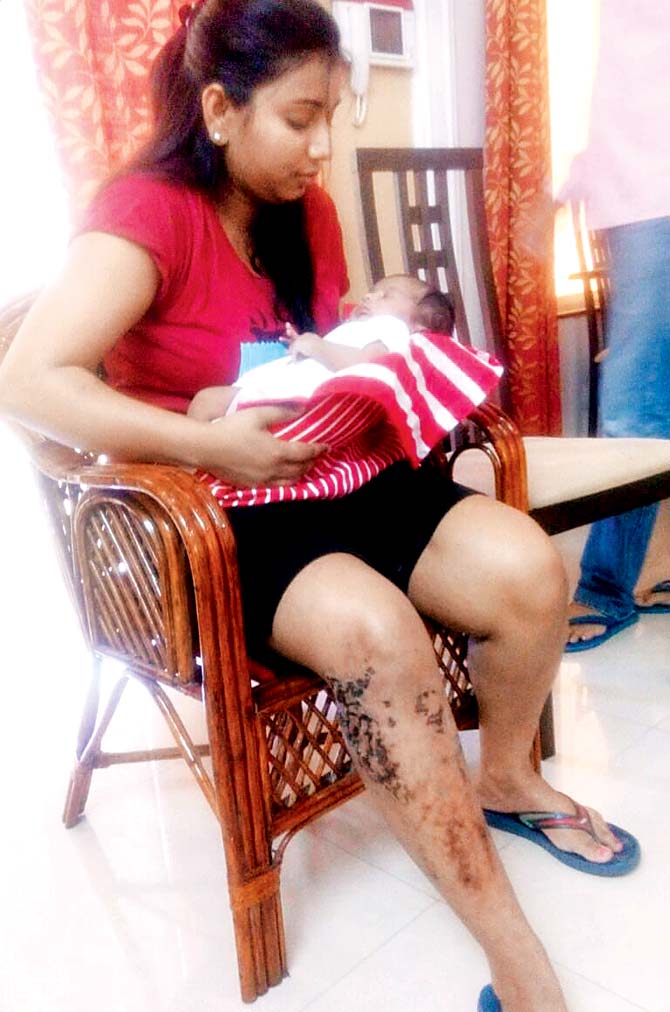Shilpa Parihar-Gill with her baby. The burn injuries on her right leg can clearly be seen