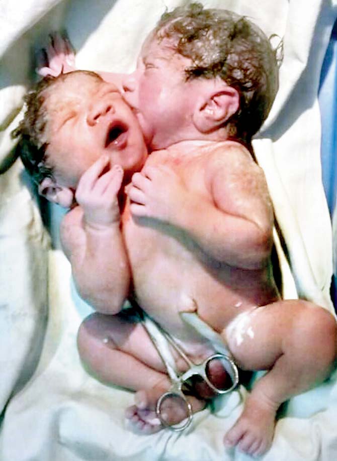 The conjoined twins were born with two heads and one heart