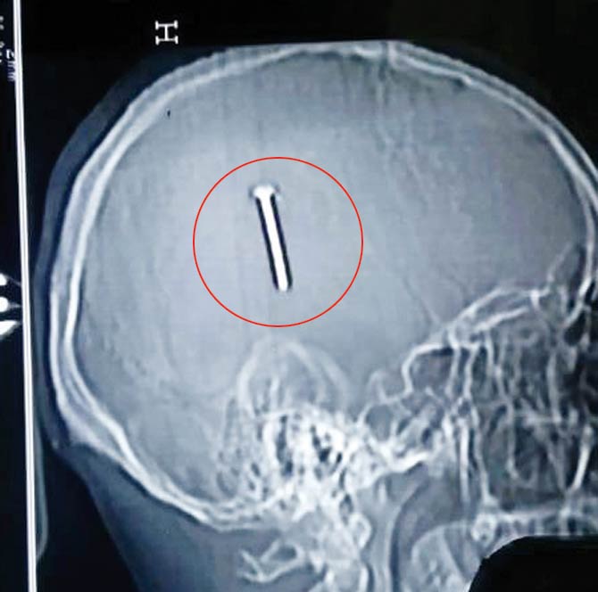 An X-ray revealed a 9-cm nail lodged inside his brain