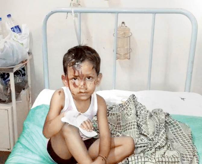 4-year-old Adarsh Singh is recovering from 30-40% burns