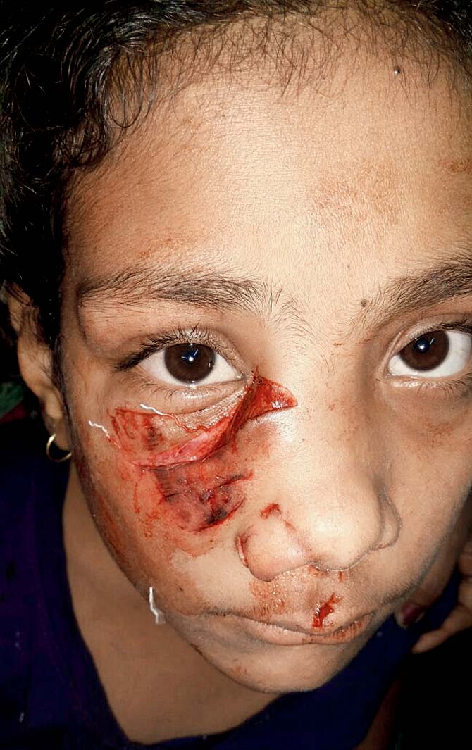 12-year-old Taniya was returning from school when the mad dog bit her in the face