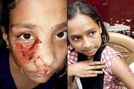 Mumbai: Crazed canine gouges girl's face, bites 13 more in Vasai