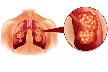 Autoantibodies may lead to early detection of lung cancer