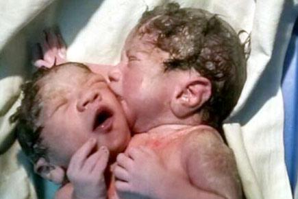 Mumbai: Rare conjoined twins sharing heart born, only 1 likely to survive