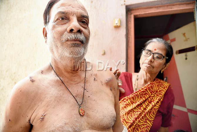 Bhikaji B shows the stitches he received after glass shards pierced his body