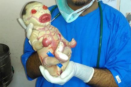 India's first 'Harlequin Baby' dies at Nagpur hospital