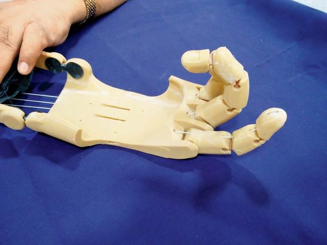 The prosthetic was made by Mulund-based Anatomiz 3D Healthcare which pegs the cost at Rs 18,000