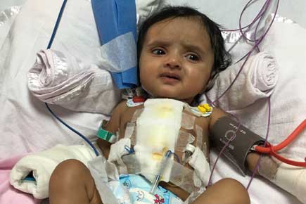 Four-month-old girl who suffered heart attacks undergoes rare heart operation at Mumbai hospital