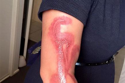 Australian woman suffers terrible burns after sleeping on iPhone7