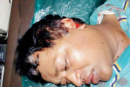 Mumbai: Boss gives staff an earful, angry workers bite off his ear
