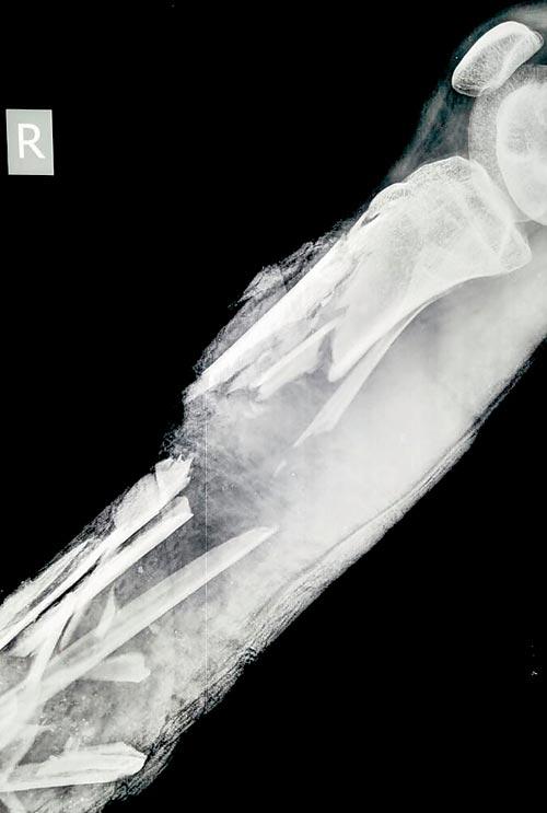 X-ray showing the broken bones of Dipesh’s leg post the accident