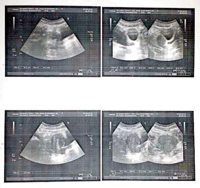 The sonography report of the foetus