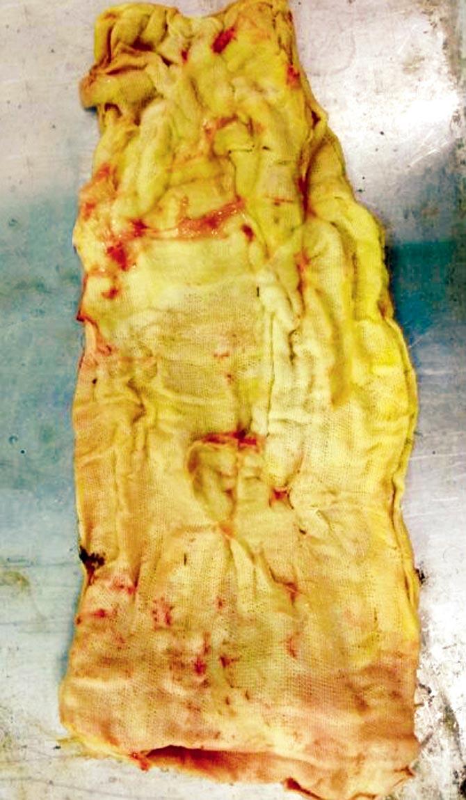 The 8in x 6in surgical mop that was removed from his stomach