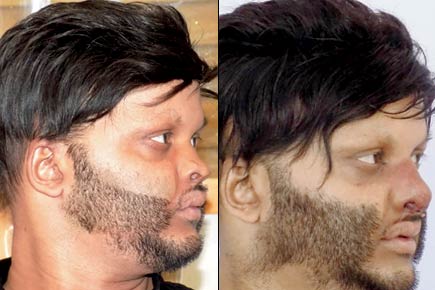 It's a first! Man gets nasal bridge from rib cartilage after surgery in Mumbai