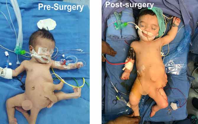 Indian doctors successfully operate on baby with eight limbs