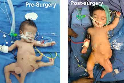 Indian doctors successfully operate on baby with eight limbs