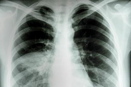 Mumbaikars beware! This lung disease without a cure is a silent killer