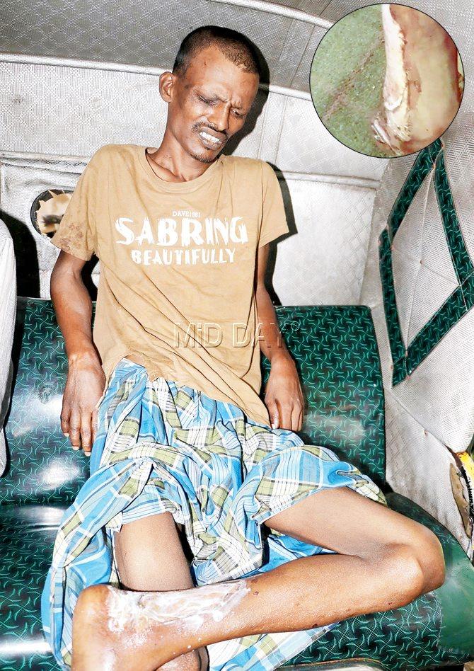 Nasir was thrashed and tortured; (inset) burn injuries on his leg. Pics/Rajesh Gupta