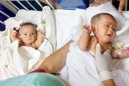 Bangladesh conjoined twins un-joined after groundbreaking surgery