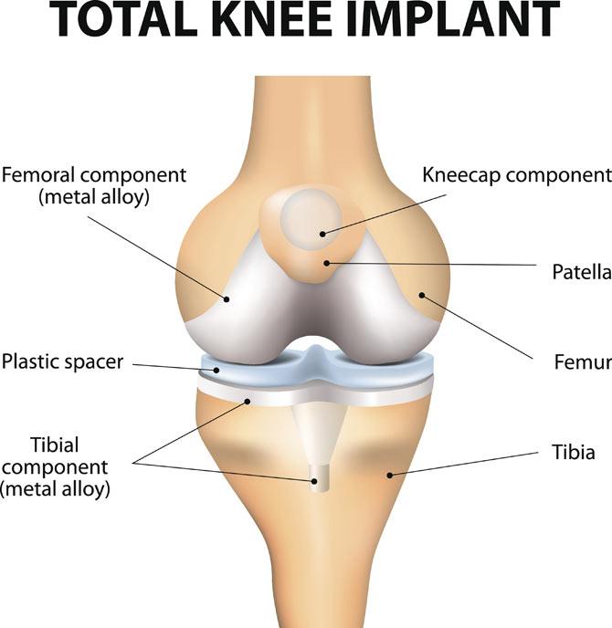 NPPA slashes knee implant cost by 70 per cent