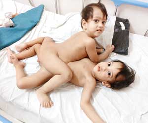 Mumbai: Doctors separate conjoined twins after 12-hour surgery