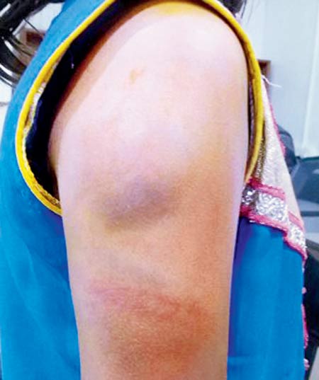 The teacher struck her repeatedly on her right arm