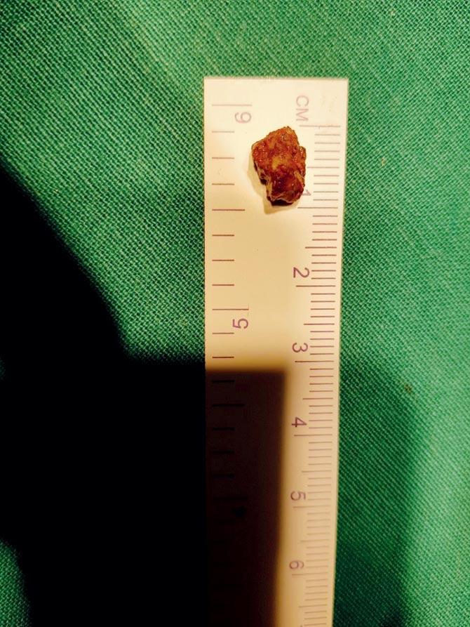 The piece of supari that was removed from toddler
