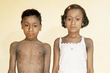 'Snake-like' Pune siblings may finally get rid of their scales