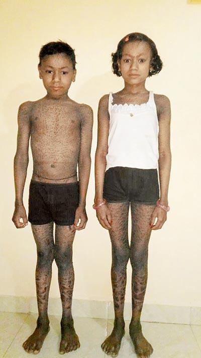 Sayali (13) and Siddhant Kapase (11) were born with a rare genetic disorder that causes abnormal scaling of the skin